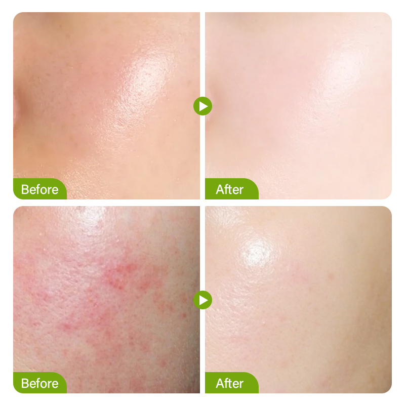 Salisilik Asit Sivilce Tedavis - Salicylic Acid Cleanser incelemesi ve fiyatı