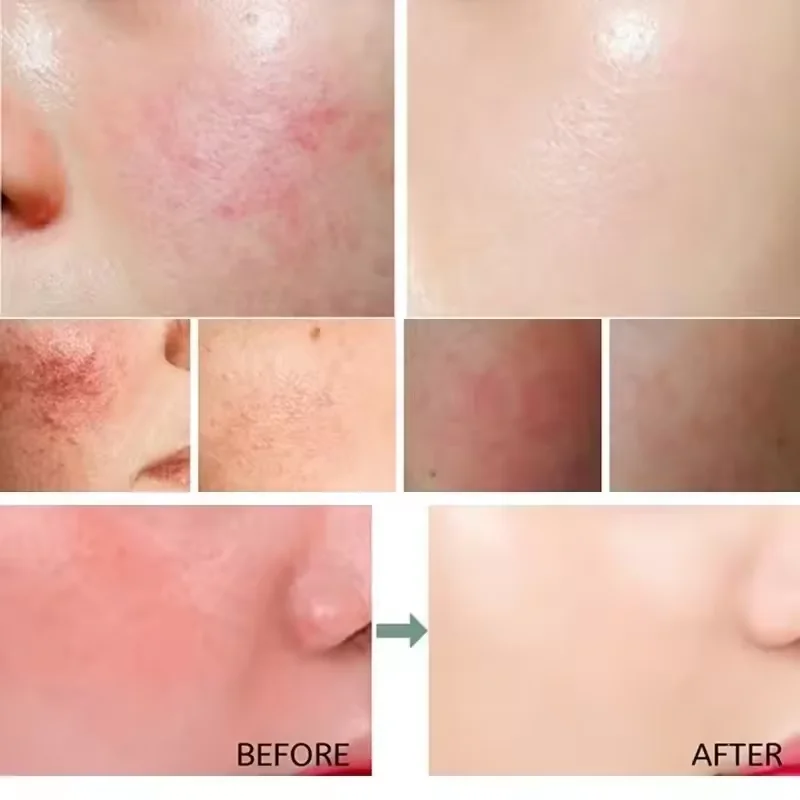 Yüz Kızarıklığı Onarıcı Krem H - Ceramide Moisturizer incelemesi ve fiyatı